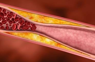 Colesterolo e rischio cardiovascolare