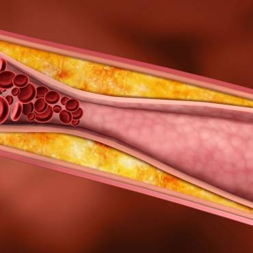 Colesterolo e rischio cardiovascolare